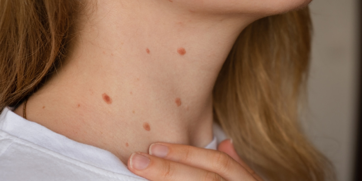 Are Skin Tags Contagious? Dermatologist Shares Insights