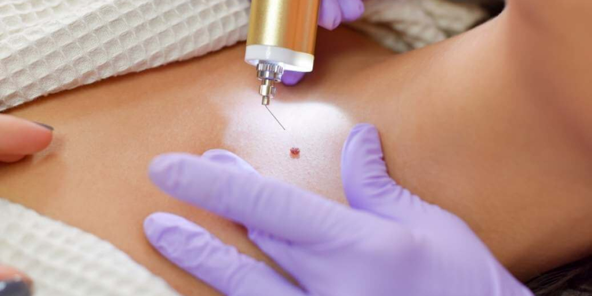 How to Prevent Warts Naturally and Effectively