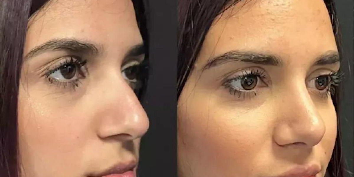 Revision Nose Surgery in Dubai for Precise and Effective Corrections