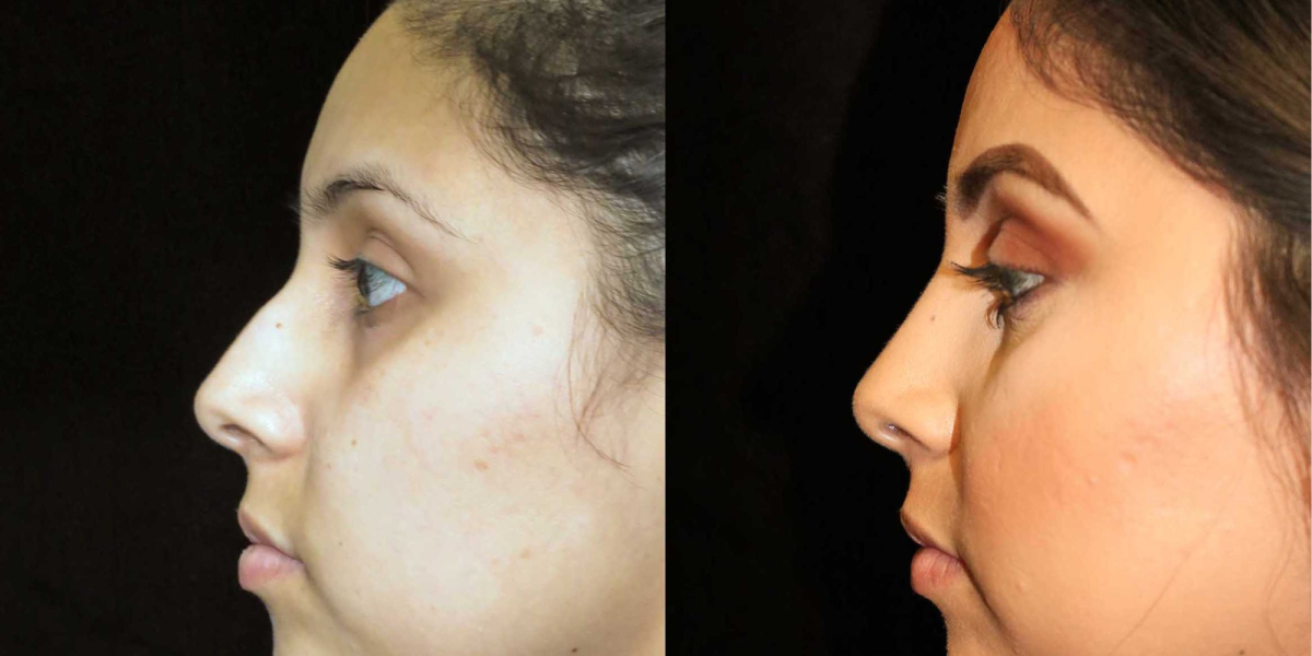 ألبوم التميز: نتائج تجميل الأنف قبل وبعد