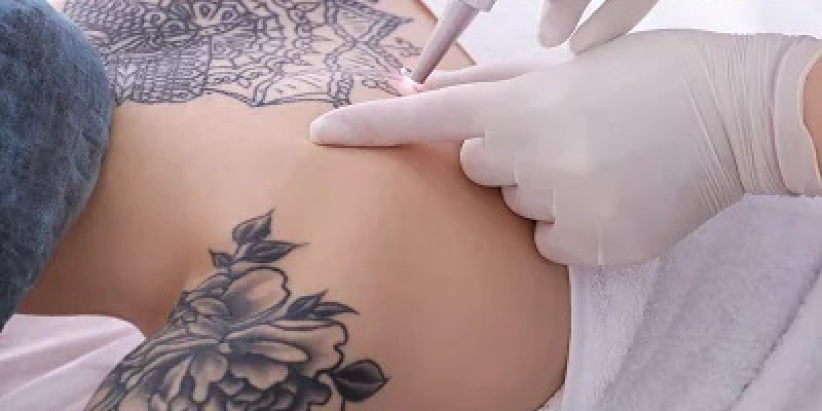 Why Laser Tattoo Removal Is Popular in Islamabad