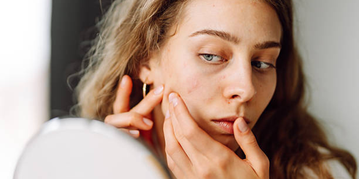 Azelaic Acid Advantages for Acne Treatment