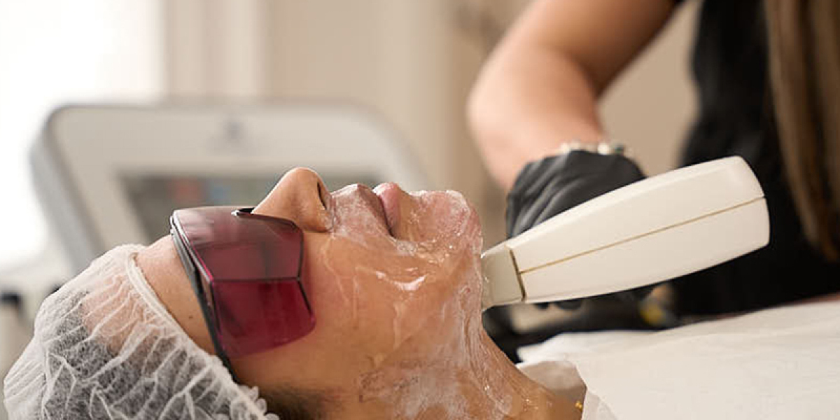 Laser for Rosacea in London – Targeted Vascular Laser Therapy to Calm Redness, Flushing and Sensitive Facial Skin