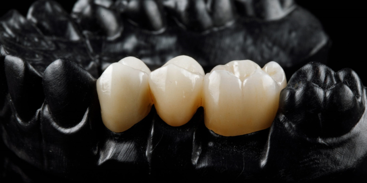 Understanding Dental Crowns and Bridges for Tooth Restoration