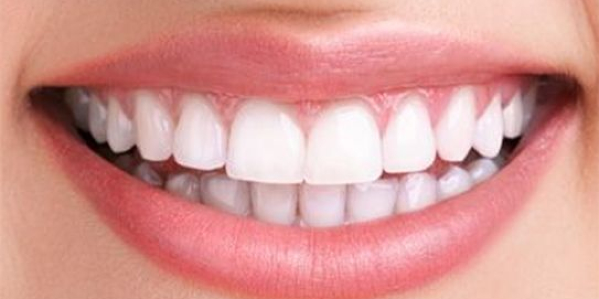Hollywood Smile in Dubai: Transform Your Smile with Expert Dentists