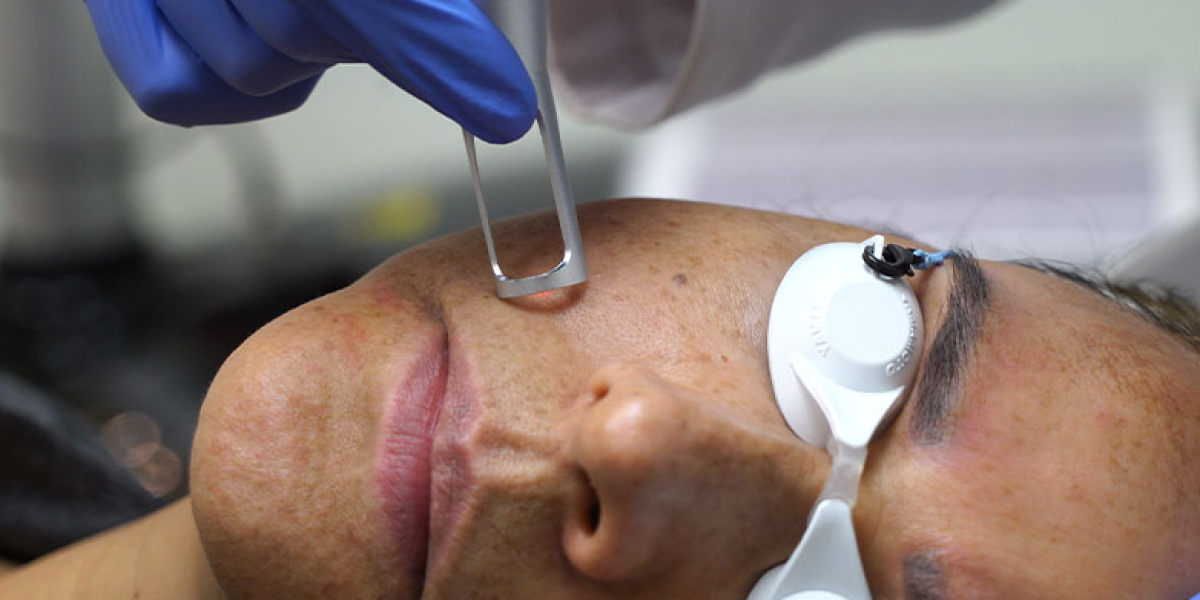Understanding How Picosure Laser Treatment Works on Pigmentation
