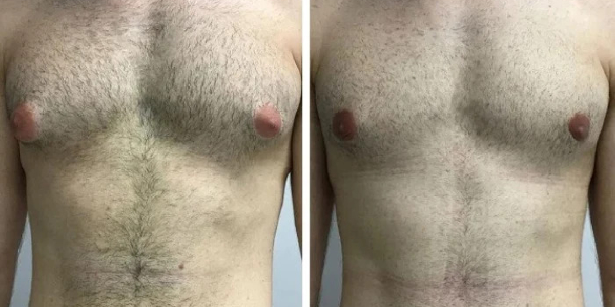 Gynecomastia in Dubai: A Guide for Teenagers and Young Adults