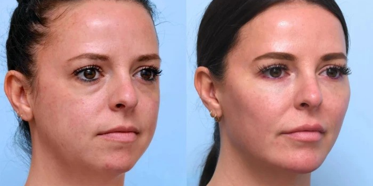 Thread Lift in Dubai Uses Innovative Techniques For Safe Facial Lifting