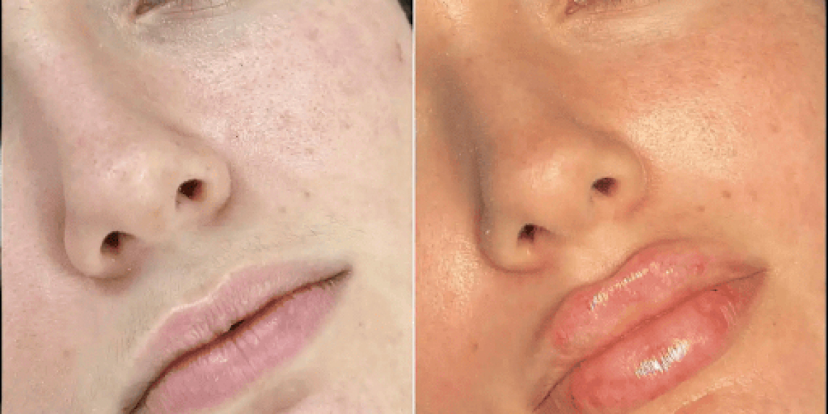 Best Doctors in dubai for Fillers for Natural, Refreshed Appearance