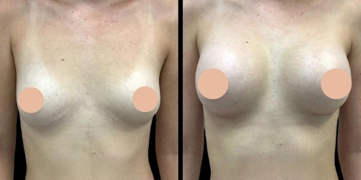 Celebrity Breast Augmentation: Trusting the Best Doctors in Dubai