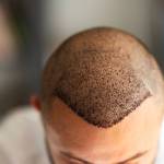 Hair Transplant in Riyadh