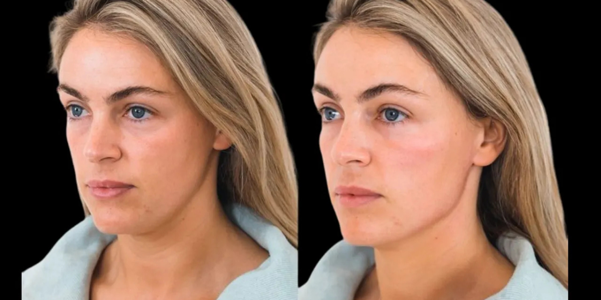 Best Aesthetic Clinic in Dubai on Cheek Fillers for All Face Shapes