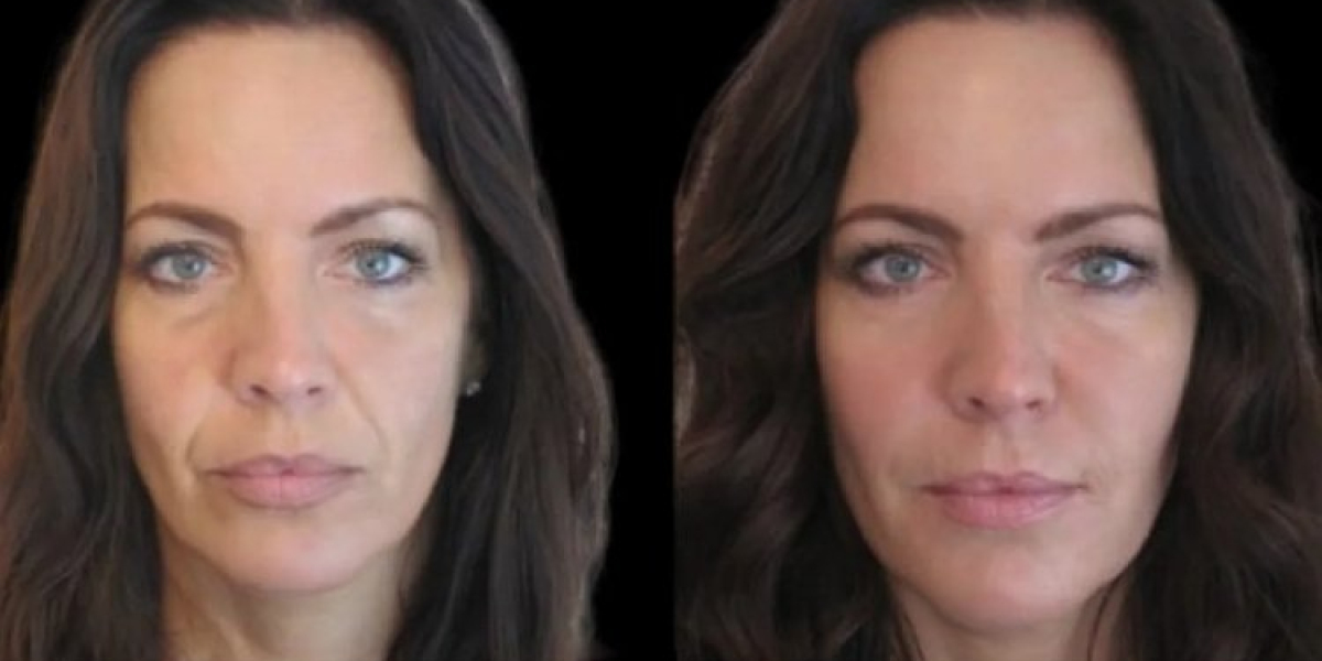 Experience the Expertise of Best Doctors in Dubai for Jawline Fillers