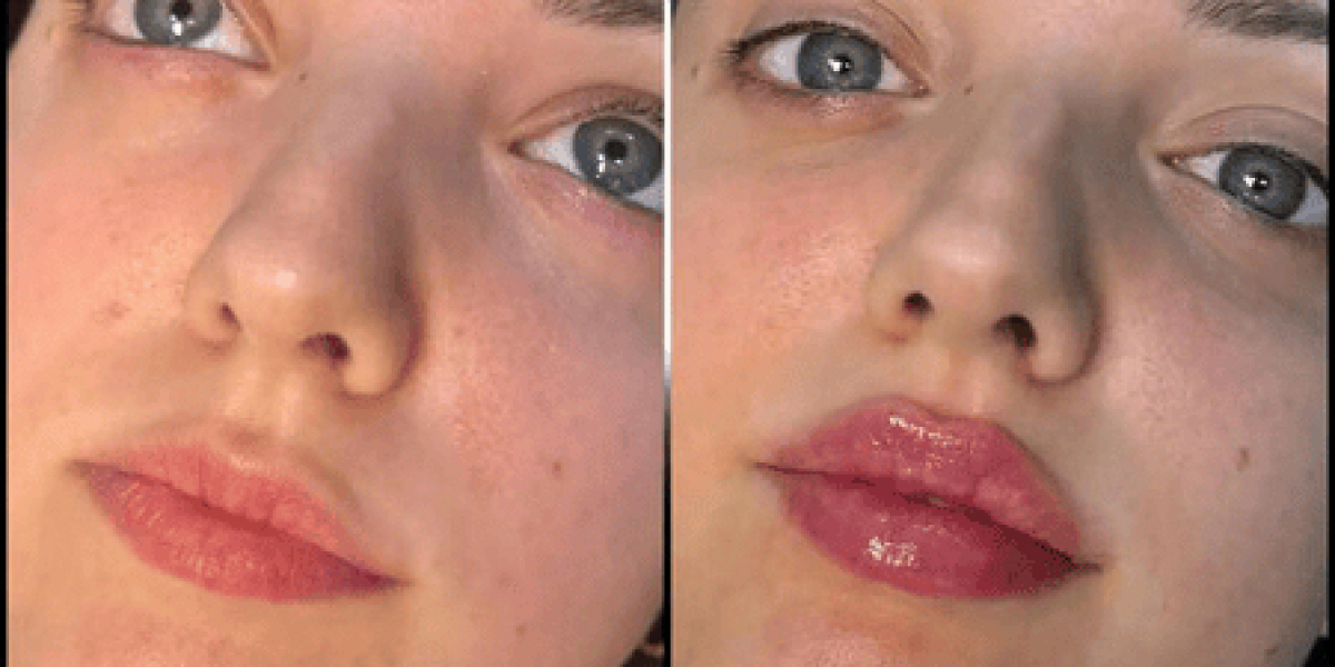 Best Doctors in dubai for Fillers with a Focus on Facial Balance