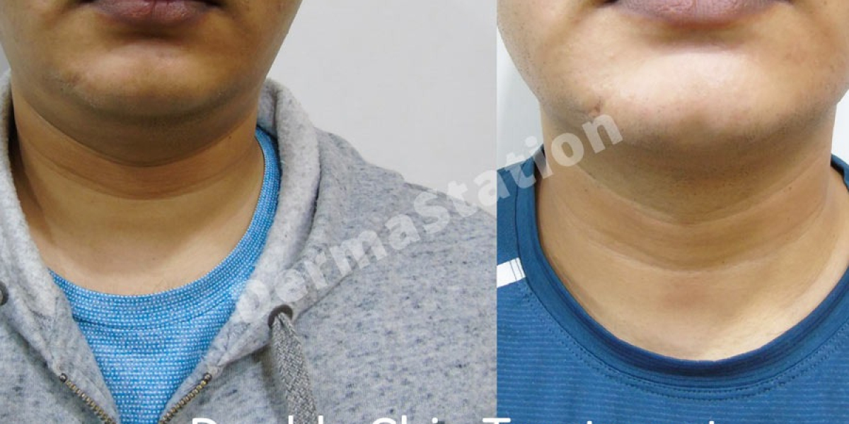 Double Chin Treatment Delhi: Causes, Solution Options, and What Works Best