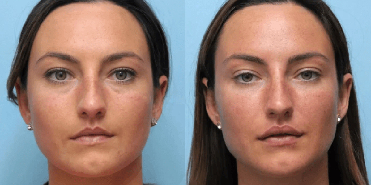 Best Doctors in Dubai Specializing in Thread Lift for Jawline Contouring and Definition
