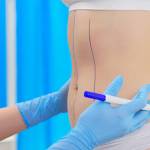 Liposuction procedure in Riyadh