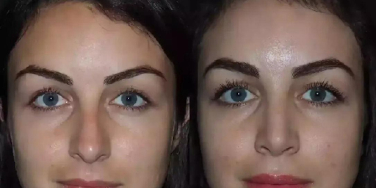 Rhinoplasty in Dubai: Advanced Surgical Techniques for Seamless Results