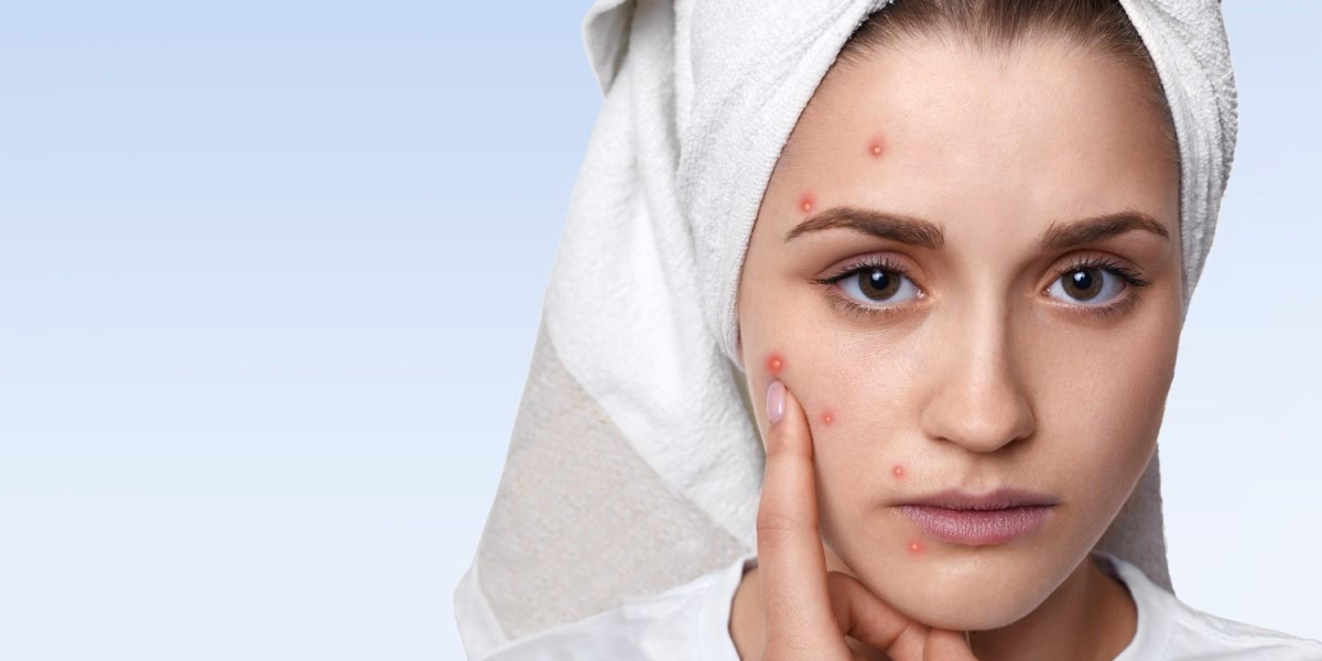 Process of PRP Treatment in Gurgaon | Dermcos Skin Care Clinic
