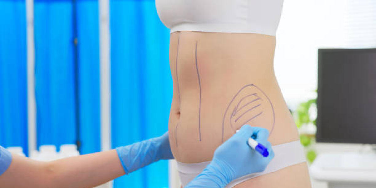 Step-by-Step Guide: How Is Liposuction Performed?