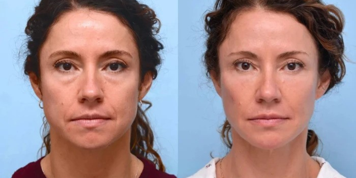Thread Lift Treatment in Dubai for Youthful and Refreshed Look