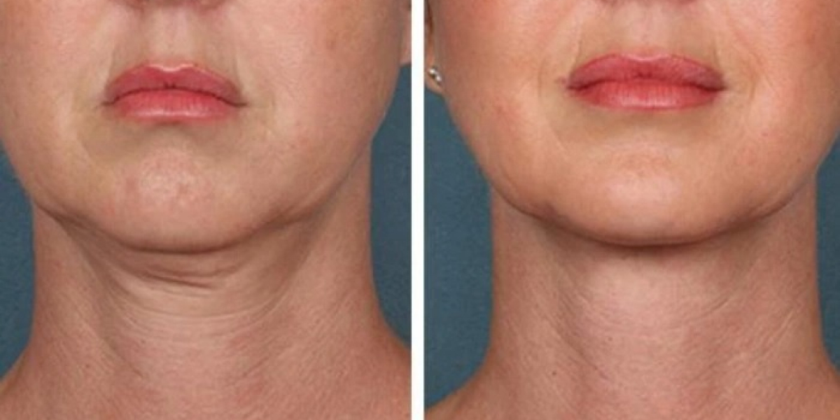 Best Aesthetic Clinic in Dubai for PRP Injection: Expert Insights