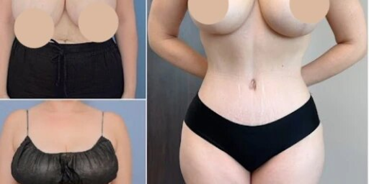 Best Doctors in Dubai for Tummy Tuck with Natural-Looking Results