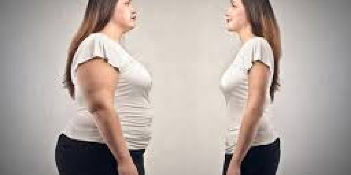 Liposuction Suitability and Ideal Candidate Guidelines