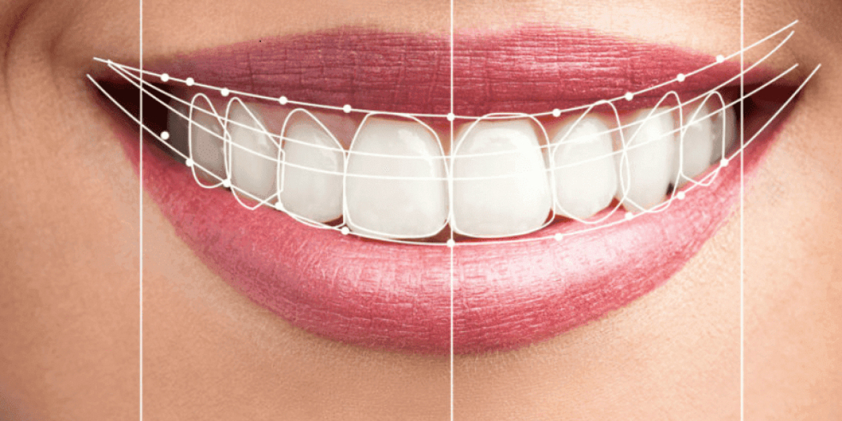 Digital Smile Design Dubai for Customized Smiles