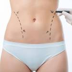 Liposuction in Riyadh Saudia
