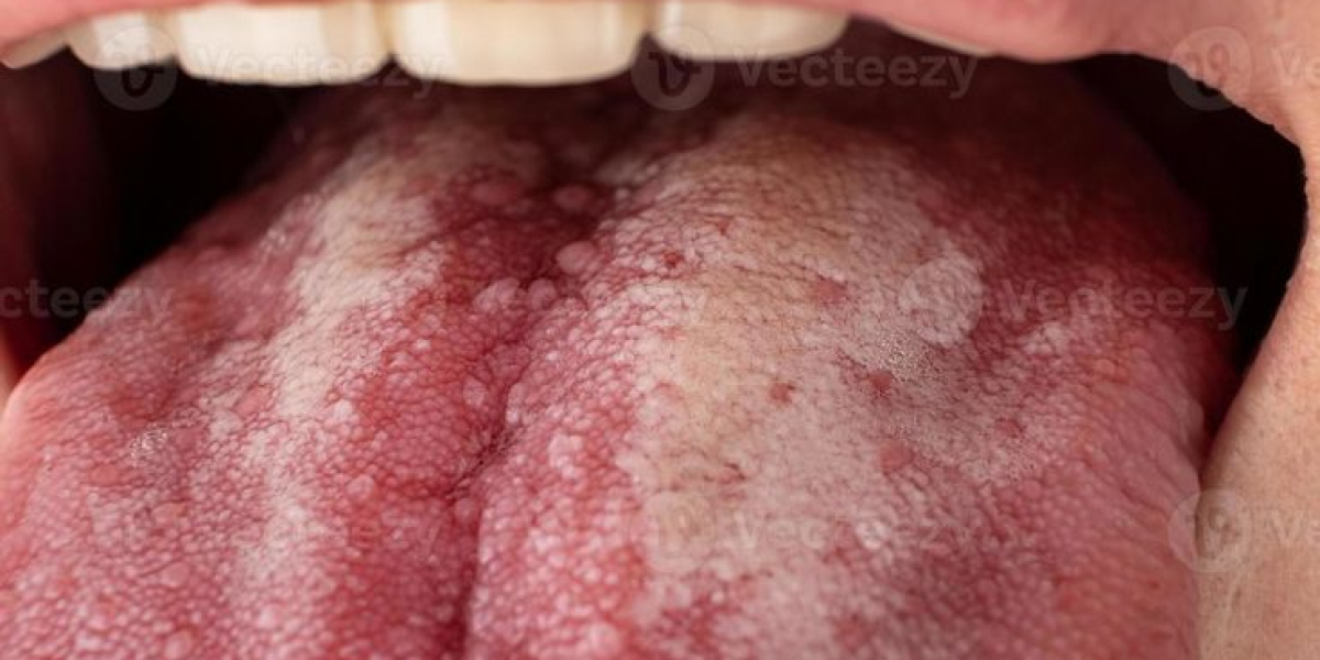 Types of Lung Cancer and Tongue Cancer Symptoms: A Comprehensive Clinical Overview