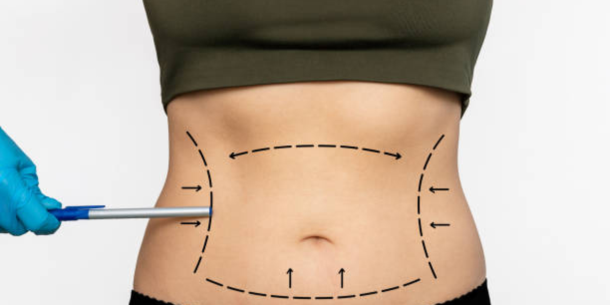 Comparing Liposuction Techniques: Find Your Ideal Body Sculpting Method