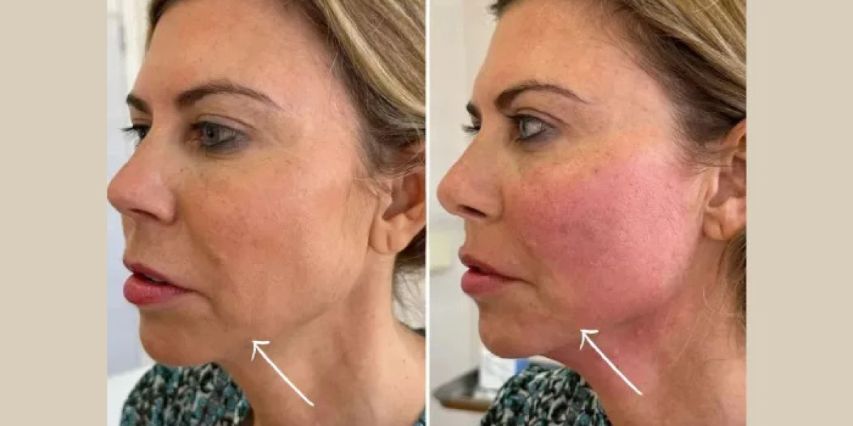 How Endolift Enhances Facial Contours at the Best Aesthetic Clinics in dubai