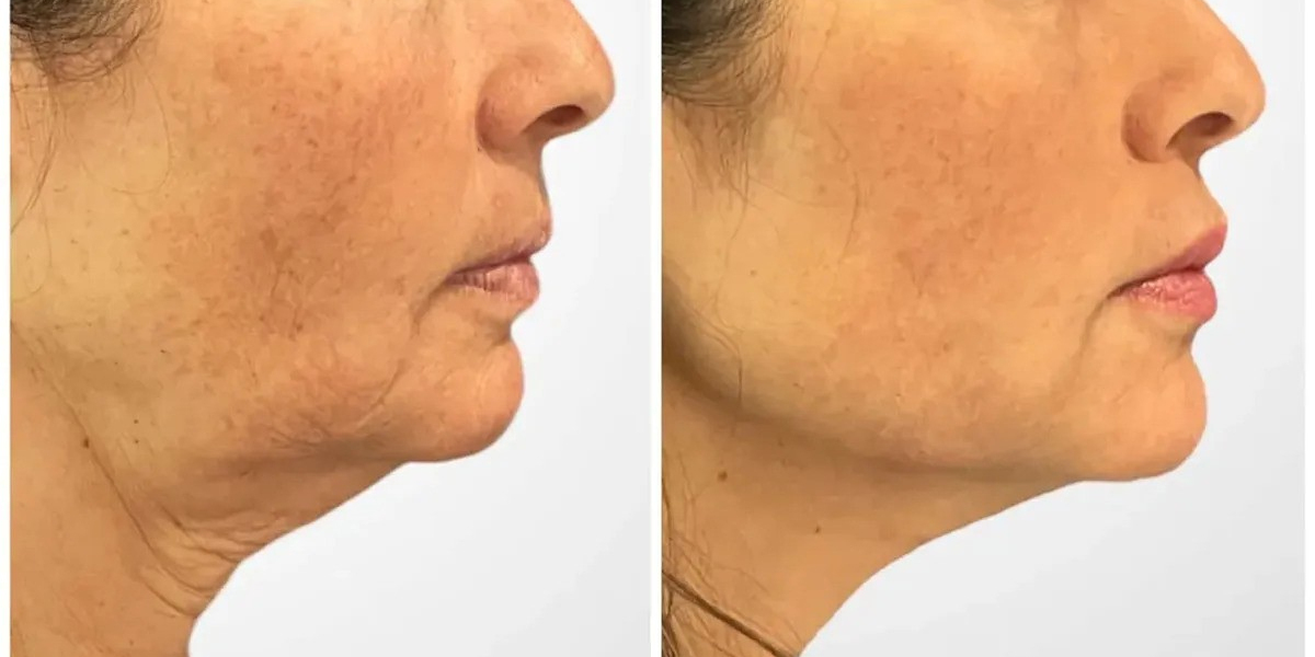 Best Aesthetic Clinics in Dubai Thread Lift Giving Smoother Lifted Features
