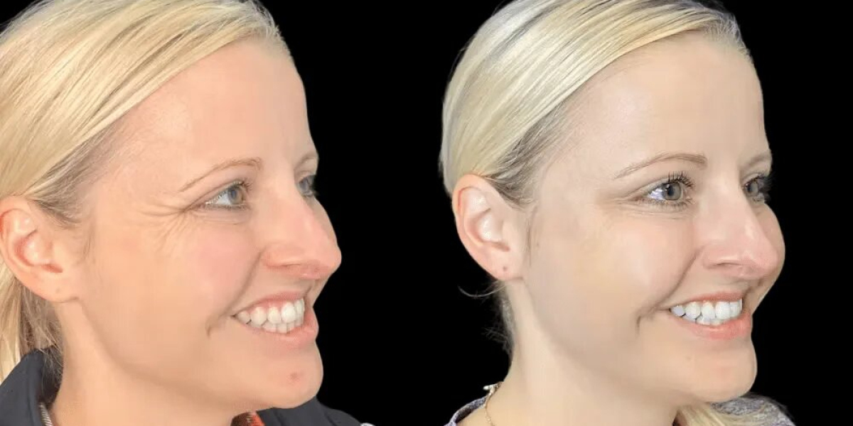 Botox First-Timers What to Expect at the Best Aesthetic Clinics in Dubai