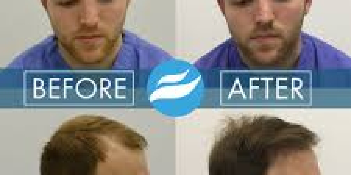 Modern Hair Transplant Solutions for Men and Women Seeking Natural, Lasting Results