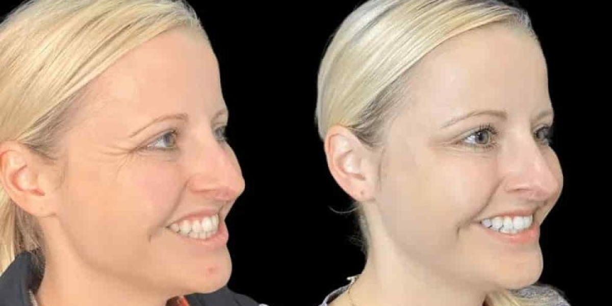 Botox Treatments in Dubai with Safe and Effective Results