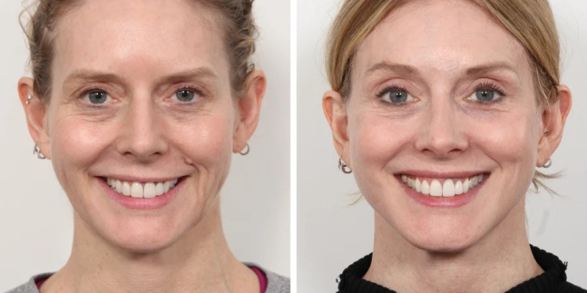 Best Doctors in dubai for Thread Lift Facial Lifting Excellence