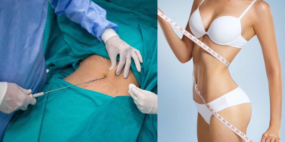 لماذا تعتبر الرياض الوجهة الأولى لشفط الدهون في الشرق الأوسط؟