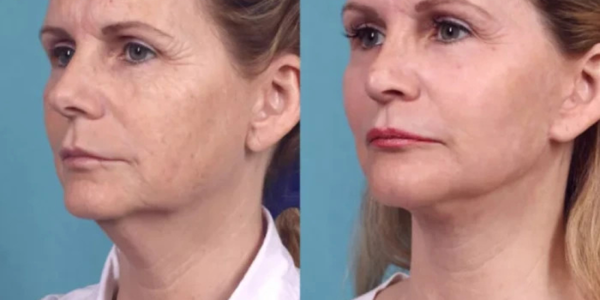 Comparing Chemical Peel Treatment in Dubai Clinics and Services