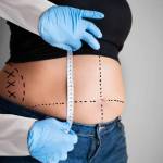 Liposuction procedure in Riyadh