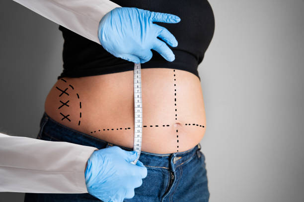 Liposuction procedure in Riyadh