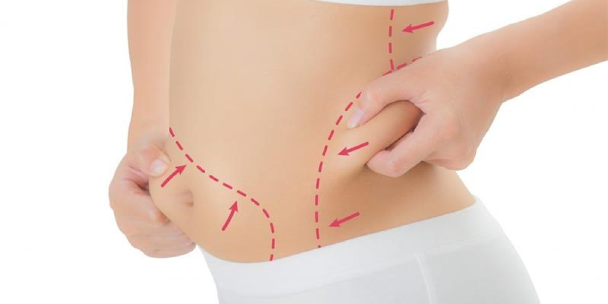 What Day Like During Liposuction Procedure?