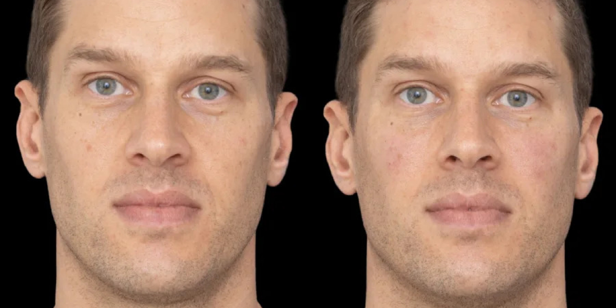 Best Aesthetic Clinic in Dubai for Under Eye Fillers Expert Care Explained