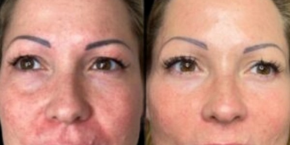 Wake Up Skin Quality with Profhilo in Dubai
