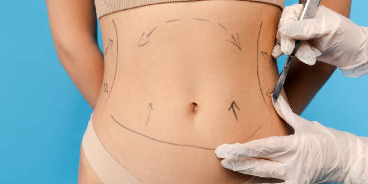 How Prepare For Fractional Liposuction Success?