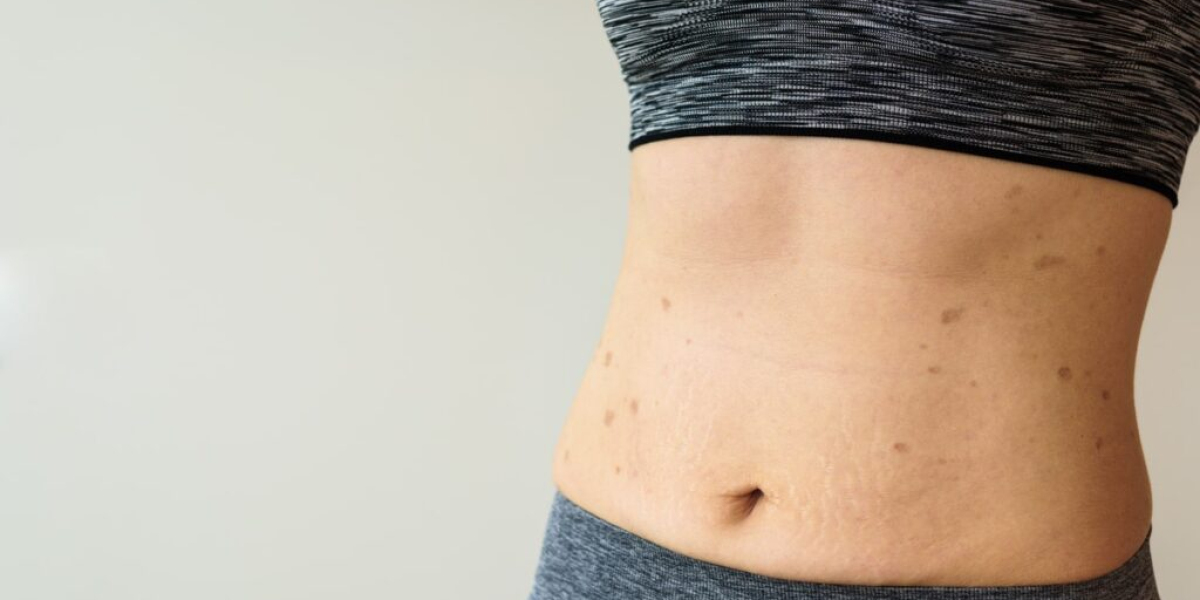 Duodenal Switch Bariatric Surgery: What to Know Before You Decide
