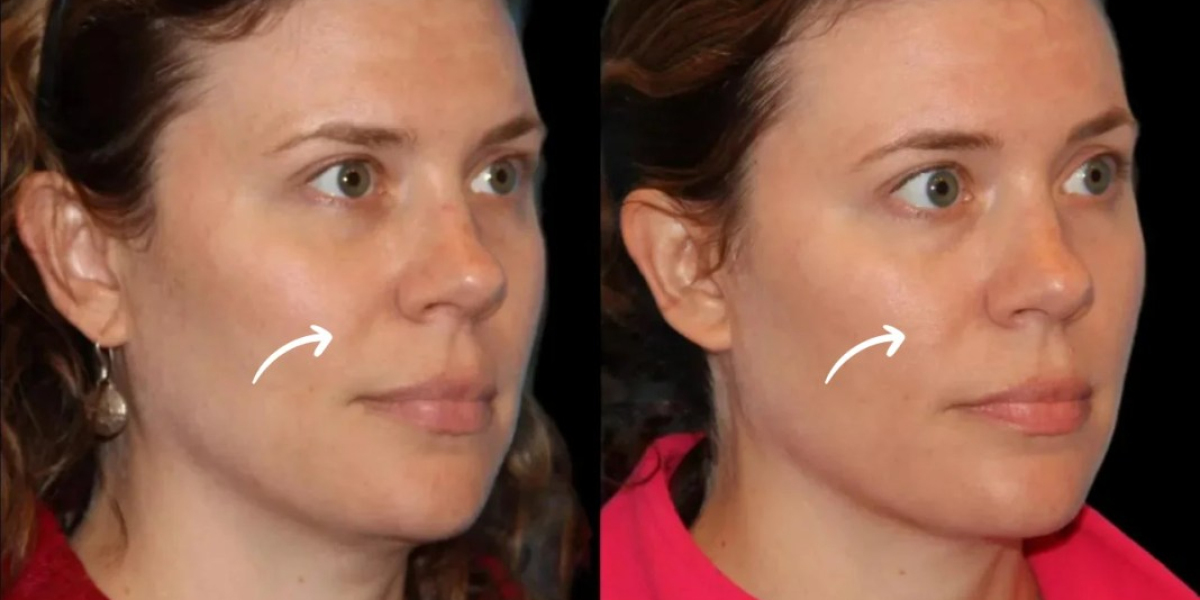 Best Aesthetic Clinic in Dubai Sculptra for Perimenopausal Skin