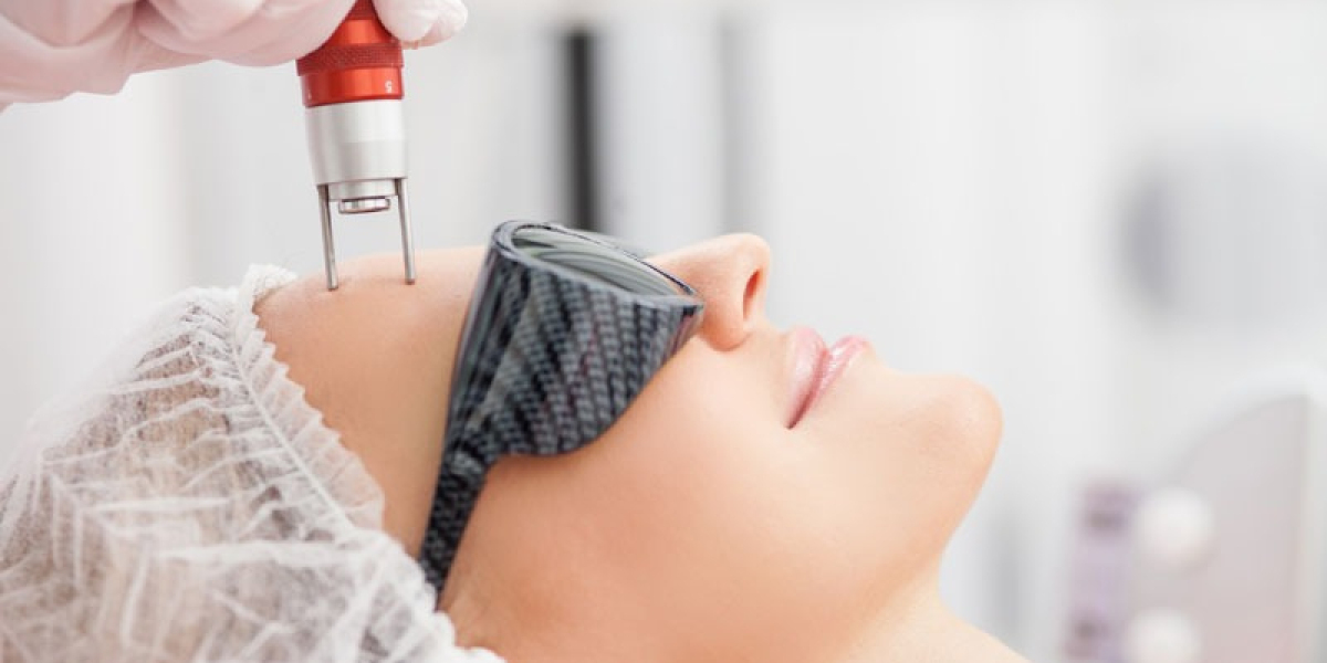 Q Switch Laser Treatment in Delhi: A Safe Dermatological Solution for Pigmentation