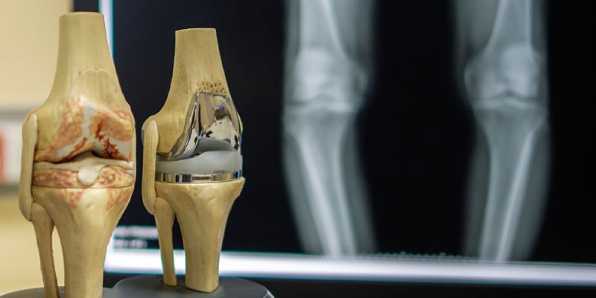 Total Knee Replacement Surgery in Delhi Explained: Separating Medical Facts from Common Myths